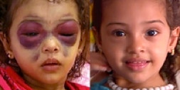 Young girl with eye problems